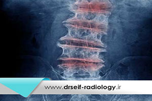 تشخیص دیسک کمر با رادیولوژی