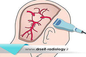 سونوگرافى داپلر ترانس كرانيال (TCD) چگونه انجام میشود؟