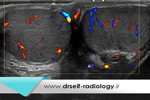 کاربرد سونوگرافی داپلر بیضه