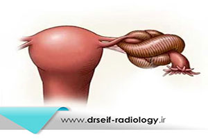 پیچ خوردگی تخمدان یا تورشن تخمدان چیست؟