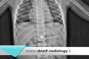 رادیوگرافی دستگاه گوارش فوقانی (Upper GI)