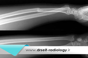تشخیص جابجایی استخوان های رادیوس و اولنا ساعد با رادیولوژی از دست