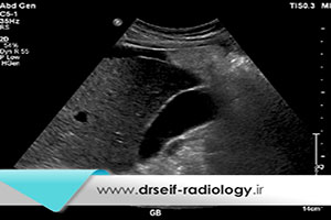 تشخیص سنگ کیسه صفرا با سونوگرافی