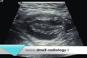 سونوگرافی تشخیص هرنی یا فتق اسکروتال