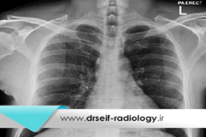 کاربرد رادیوگرافی قفسه سینه (chest x-ray)