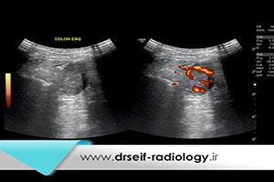 آیا تشخیص سرطان روده با سونوگرافی امکان پذیر است؟