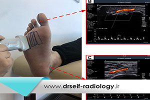 سونوگرافی داپلر وریدهای اندام تحتانی