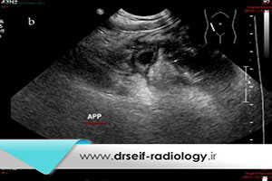 ارزش تشخیصی سونوگرافی در بیماران مشکوک به آپاندیسیت حاد