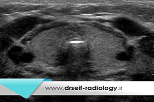 بررسی میانگین حجم تیروئید افراد نرمال با سونوگرافی