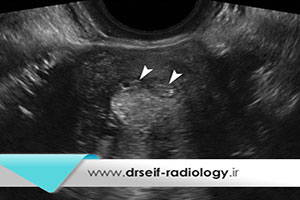 سونوگرافی آندومتریوز چیست و چه کاربردی دارد؟