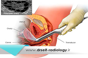 سونوگرافی ترانس واژینال یا داخلی چیست و چگونه انجام میشود؟