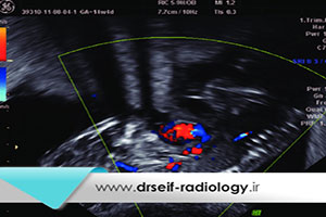 ضرورت انجام سونوگرافی کالر داپلر در بارداری