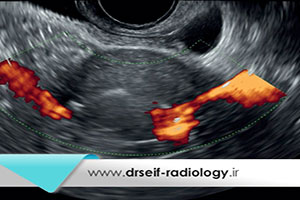سونوگرافی کالر داپلر واژینال رحم و تخمدان