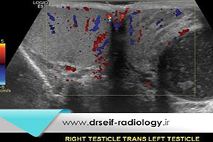 آمادگی برای سونوگرافی بیضه
