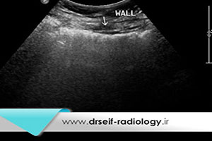 آیا سونوگرافی سیستیت را نشان می دهد؟