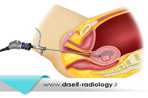 هیستروسونوگرافی چیست و چگونه انجام میشود؟