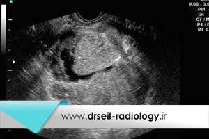 تشخیص سرطان تخمدان با سونوگرافی