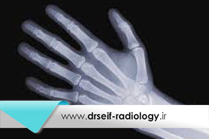 کنترل و پیشرفت پوکی استخوان با رادیولوژی اشعه ایکس