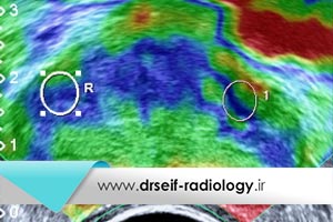 مراحل انجام سونوگرافی الاستوگرافی پروستات