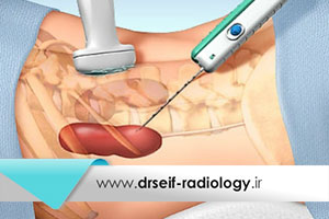 بیوپسی کلیه تحت گاید سونوگرافی