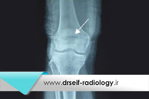 بررسی دقت اشعه ایکس در تشخیص ضایعات تروماتیک زانو