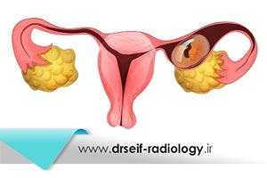 از کجا بفهمیم بارداری خارج از رحم است؟