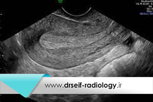 سونوگرافی رحم و تخمدان جهت تشخیص سرطان رحم