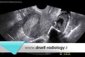 بهترین زمان سونوگرافی برای تشخیص اندومتریوز