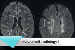 تشخیص بیماری ام اس با رادیولوژی