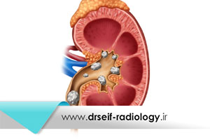 اهمیت بررسی اندازه سنگ کلیه با سونوگرافی