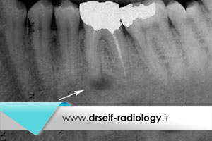 رادیوگرافی برای تشخیص آبسه دندان
