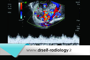 سونوگرافی بهترین روش تشخیص بیماری های تروفوبلاستیک بارداری