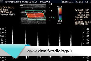 با انواع سونوگرافی داپلر آشنا شوید