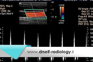 سونوگرافی داپلر دوبلکس چه کاربردی دارد؟