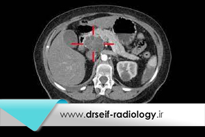ارزیابی و تشخیص سرطان پانکراس با سی تی اسکن