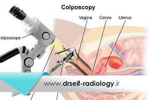 کولپوسکوپی دهانه رحم چیست و روند انجام آن چگونه است؟