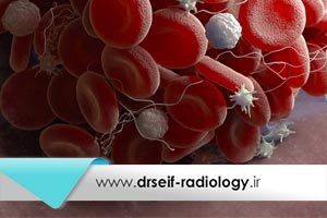 ترومبوسیتوپنی یا افت پلاکت خون چگونه تشخیص داده میشود
