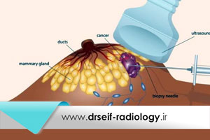 علت انجام و انواع روشهای بیوپسی یا نمونه برداری از پستان
