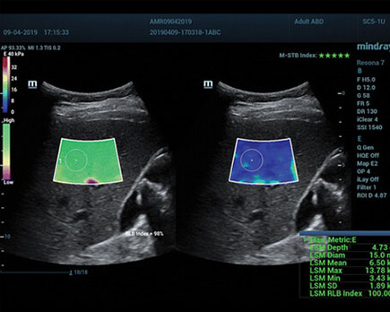 الاستوگرافی تیروئیدچیست؟ | هزینه الاستوگرافی تیروئید در تهران