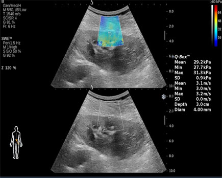 مقایسه الاستوگرافی و سونوگرافی در تشخیص و کاربرد