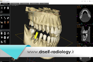 عکس CBCT دندان | هزینه عکس سی بی سی تی دندان