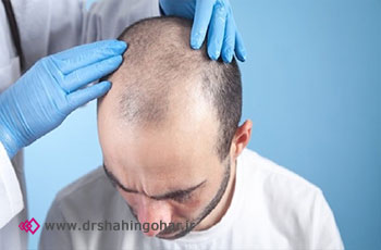همه چیز درباره کاشت مو