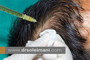 تزریق PRP برای حفظ فولیکول ها پس از کاشت مو