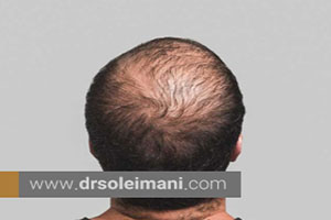انواع روشهای ترمیم مو برای بیماران مبتلا به بیماریهای خاص