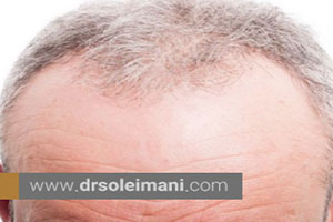 علت اصلی ریزش مو در جلوی سر