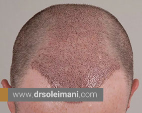 دلایل ترک پوست سر پس از کاشت مو طبیعی چیست؟
