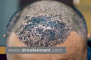 علت عفونت بعد از کاشت مو چیست؟