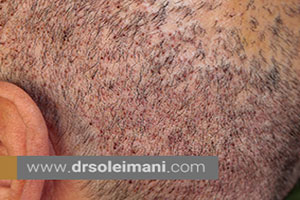 علت چرب شدن و ترشحات پوست سر بعد از کاشت مو