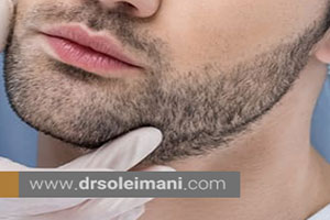 عوامل موثر بر هزینه کاشت ریش