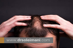 عوامل مؤثر در ریزش موی مردان